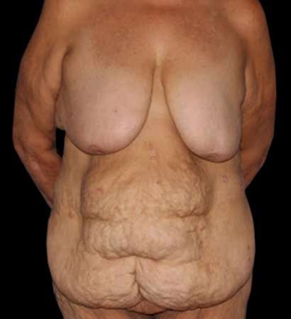 Fleur De Lis Circumferential Body Lift Before & After Patient #2685