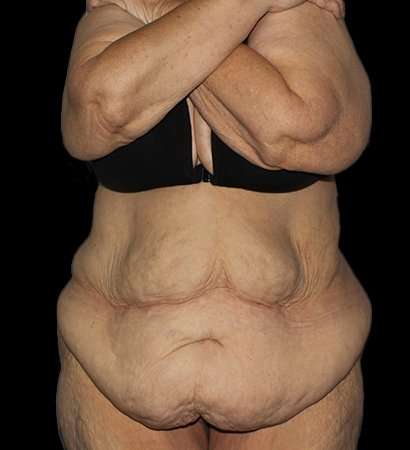Fleur De Lis Tummy Tuck Before & After Patient #2692
