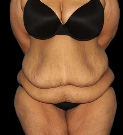 Fleur De Lis Tummy Tuck Before & After Patient #2703