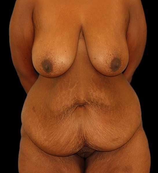 Fleur De Lis Tummy Tuck Before & After Patient #2714