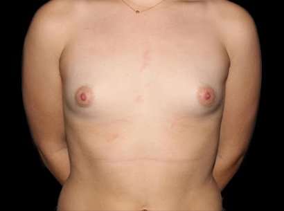 Breast Augmentation - Implant Before & After Patient #1050