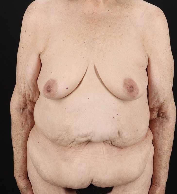 Fleur De Lis Tummy Tuck Before & After Patient #2727