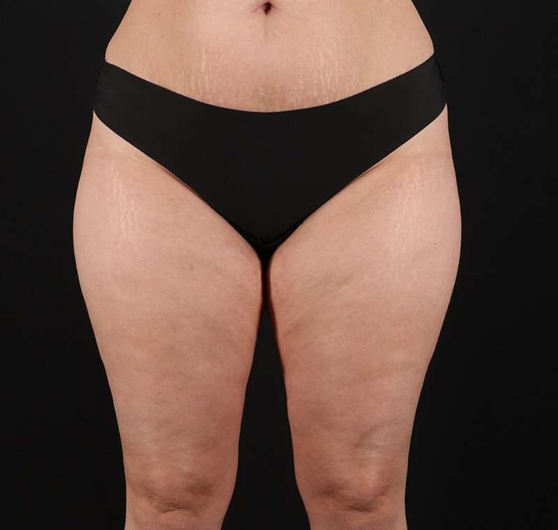 Liposuction Before & After Patient #2736