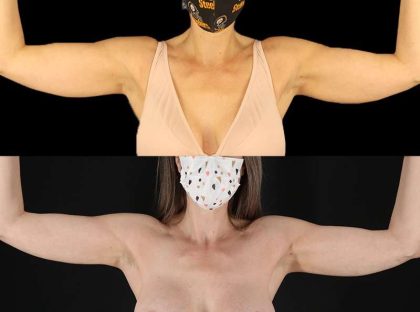 Liposuction Before & After Patient #2743