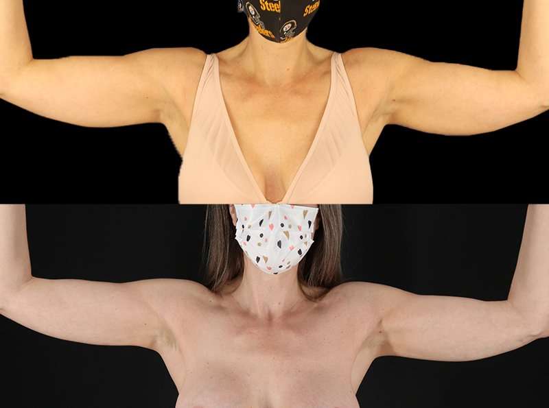 Liposuction Before & After Patient #2743