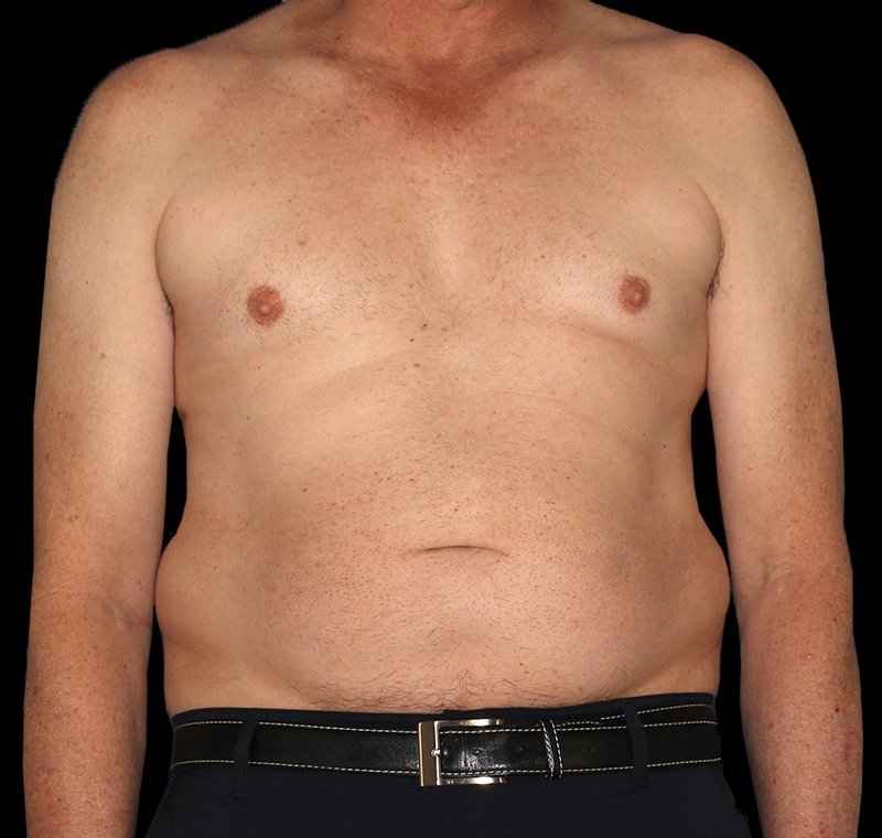 Liposuction Before & After Patient #2756