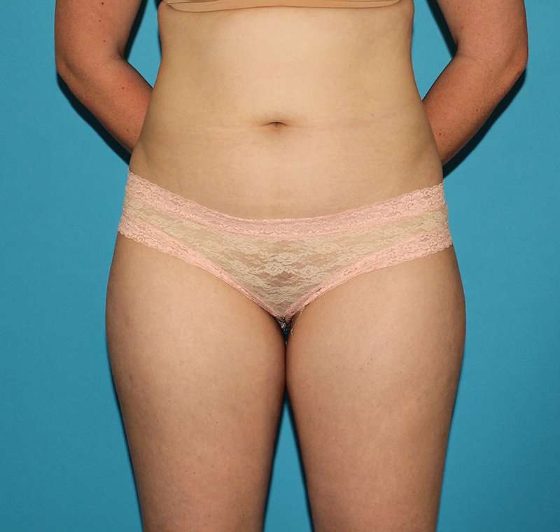 Liposuction Before & After Patient #2767