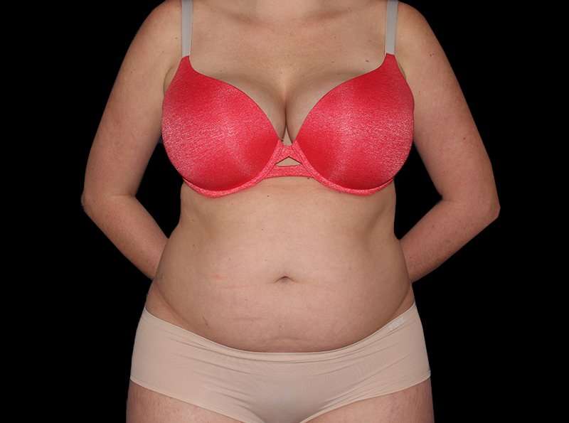 Liposuction Before & After Patient #2778