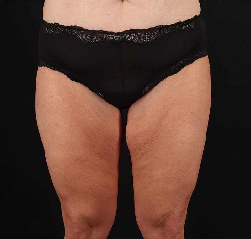 Liposuction Before & After Patient #2816