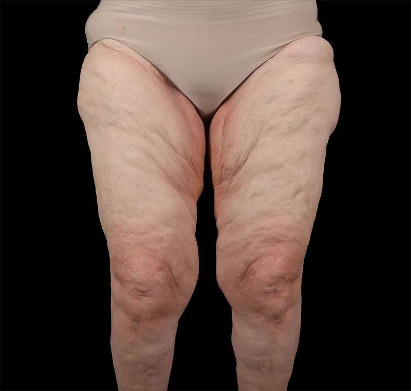 Liposuction Before & After Patient #2829