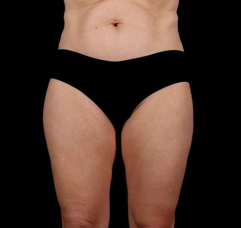 Liposuction Before & After Patient #2834