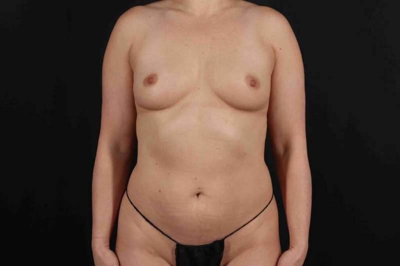 Liposuction Before & After Patient #2845