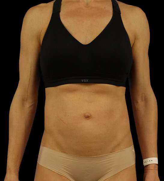 Mini Tummy Tuck Before & After Patient #2856