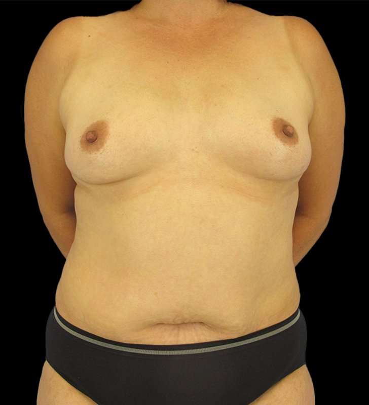 Mommy Makeover Before & After Patient #2878