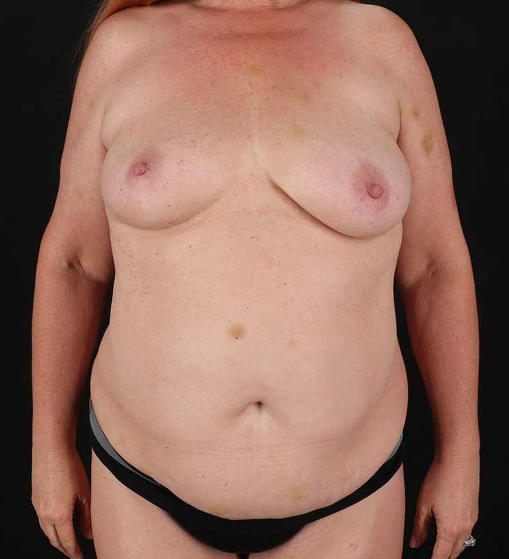 Mommy Makeover Before & After Patient #2913