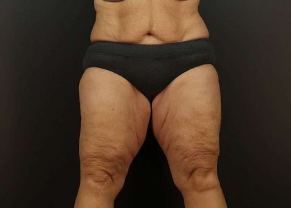Thigh Lift Before & After Patient #2979