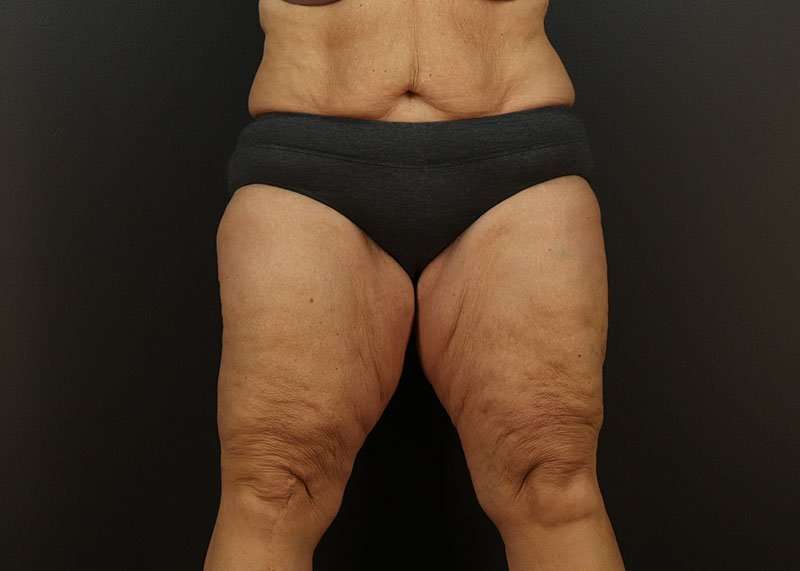 Thigh Lift Before & After Patient #2979