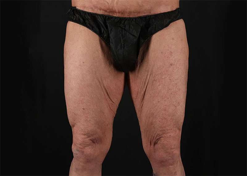 Thigh Lift Before & After Patient #2992