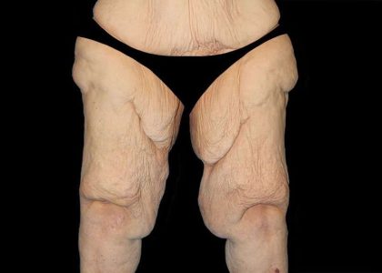 Thigh Lift Before & After Patient #3005