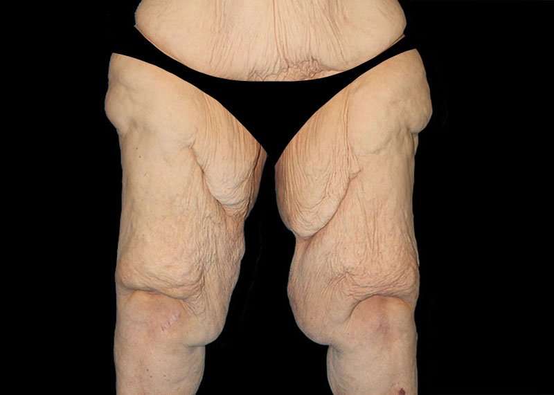 Thigh Lift Before & After Patient #3005