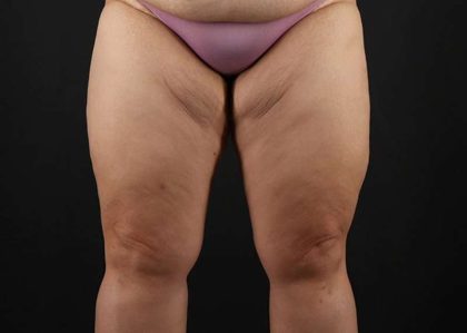Thigh Lift Before & After Patient #3018