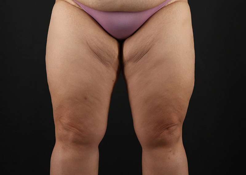 Thigh Lift Before & After Patient #3018