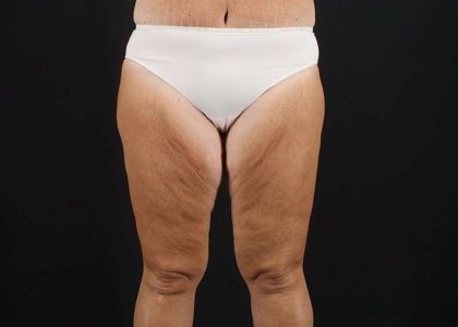 Thigh Lift Before & After Patient #3031
