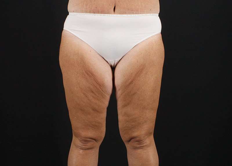 Thigh Lift Before & After Patient #3031