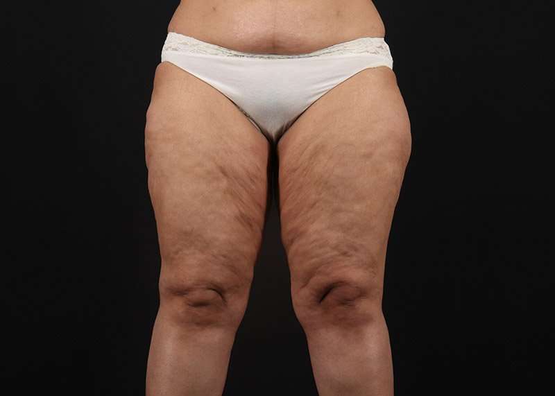 Thigh Lift Before & After Patient #3044