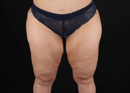 Thigh Lift Before & After Patient #3057