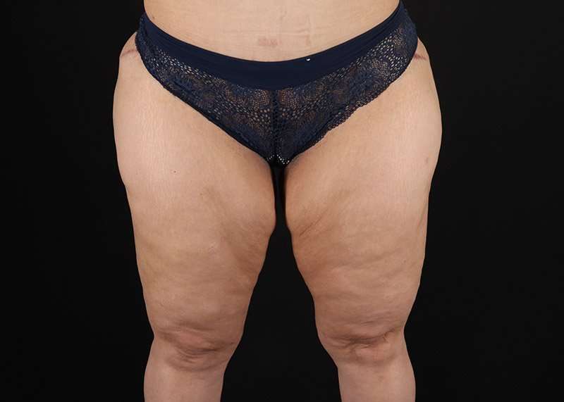Thigh Lift Before & After Patient #3057