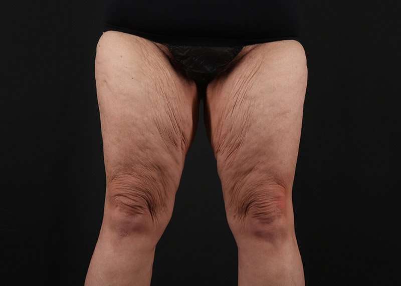 Thigh Lift Before & After Patient #3070