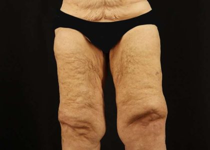 Thigh Lift Before & After Patient #3083