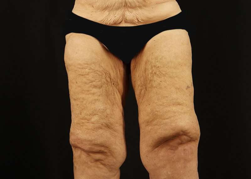 Thigh Lift Before & After Patient #3083