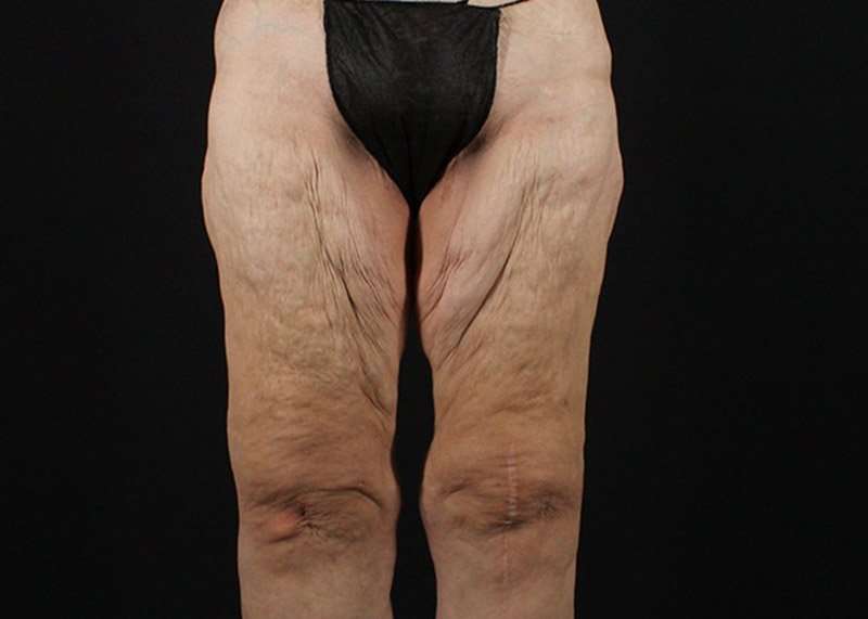 Thigh Lift Before & After Patient #3096
