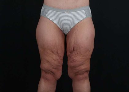 Thigh Lift Before & After Patient #3109