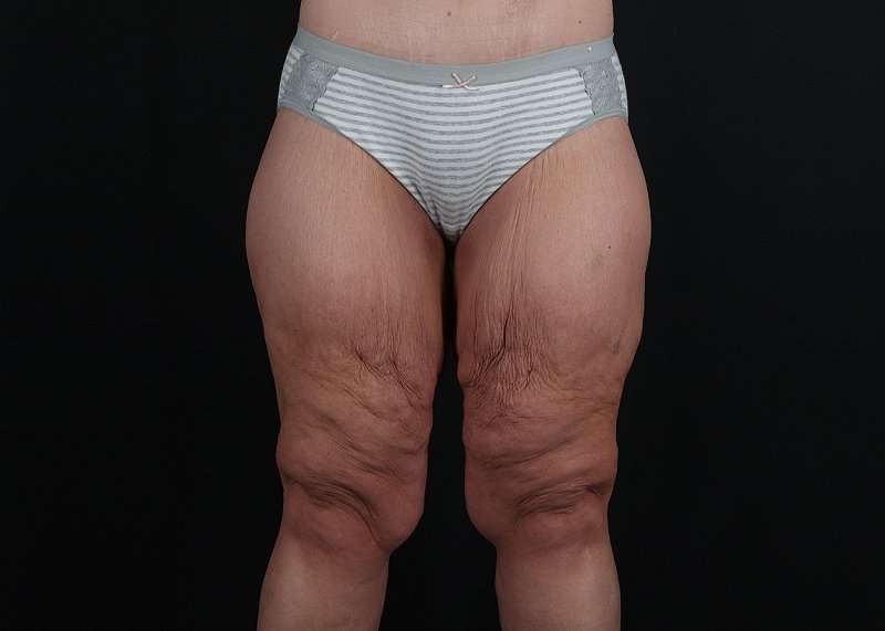 Thigh Lift Before & After Patient #3109