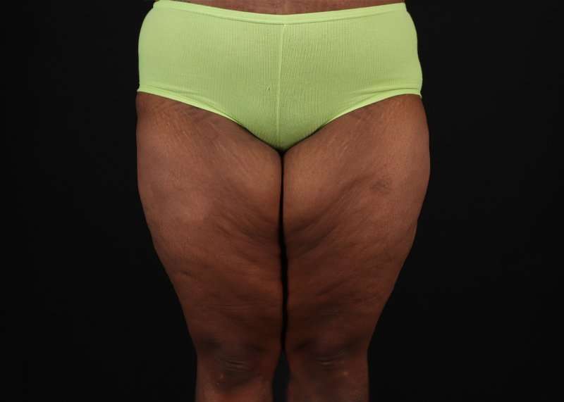 Thigh Lift Before & After Patient #3122