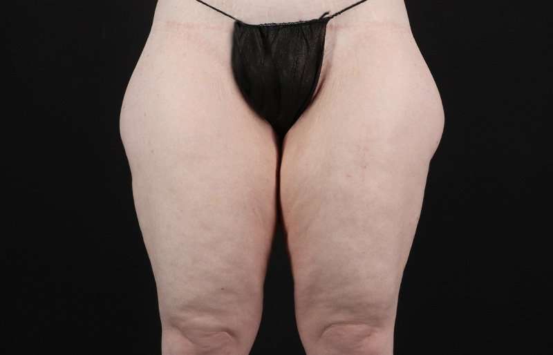 Thigh Lift Before & After Patient #3135