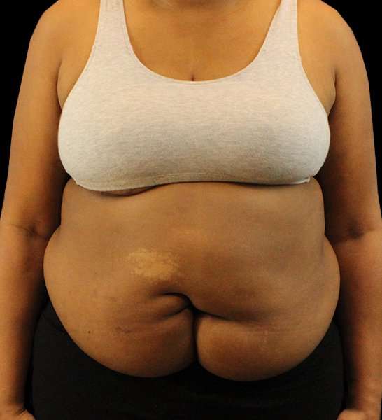 Tummy Tuck Revision Before & After Patient #3146
