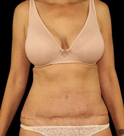 Tummy Tuck Revision Before & After Patient #3157