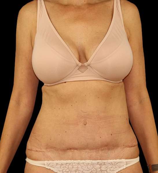 Tummy Tuck Revision Before & After Patient #3157