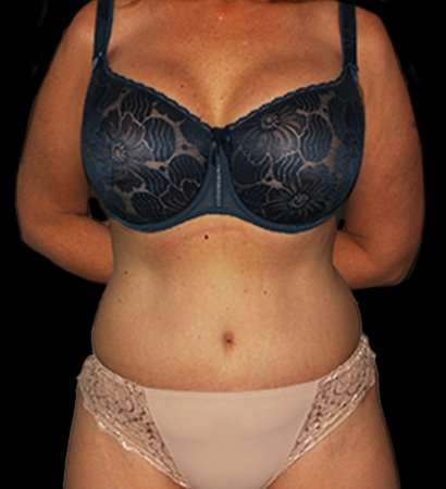 Tummy Tuck Revision Before & After Patient #3168