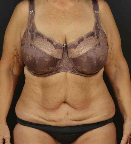 Tummy Tuck Revision Before & After Patient #3181