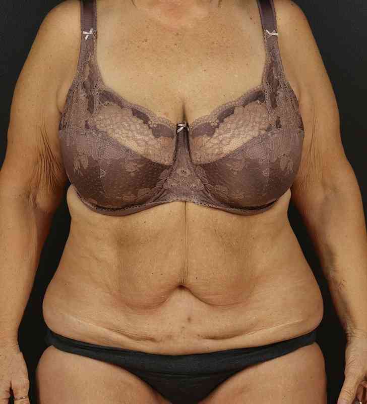 Tummy Tuck Revision Before & After Patient #3181