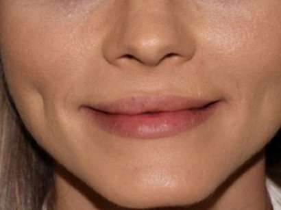 Lip Augmentation - Fat Grafting Before & After Patient #3210
