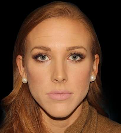 Botox Before & After Patient #3217
