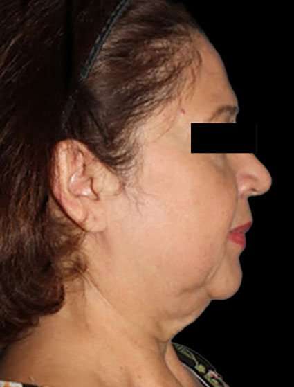 Face & Neck Lift Before & After Patient #3248