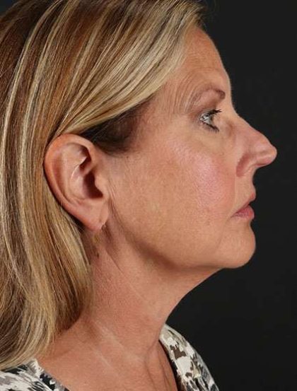 Face & Neck Lift Before & After Patient #3259