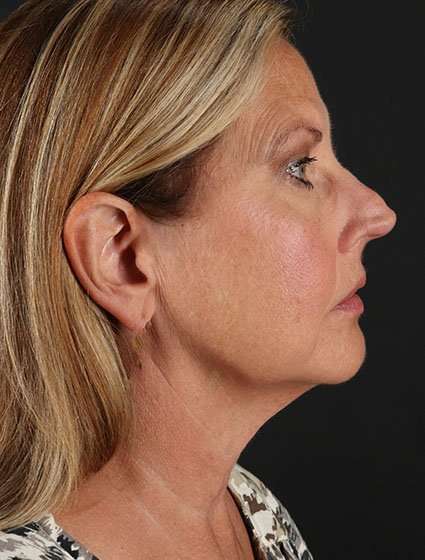 Face & Neck Lift Before & After Patient #3259